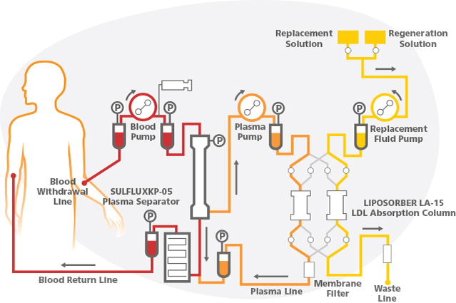 Apheresis Illustration