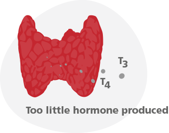 Hyp0thyroidism